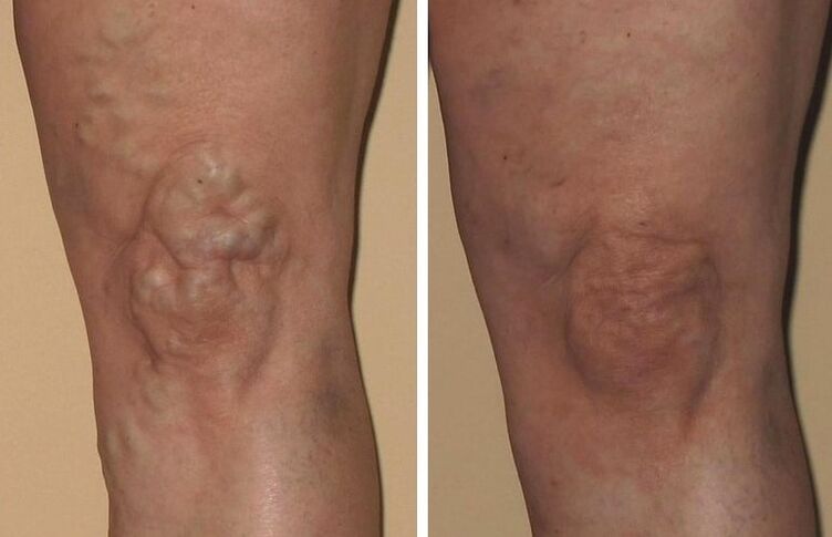 Experience of using Veniselle by Alice from Prague, before and after photos