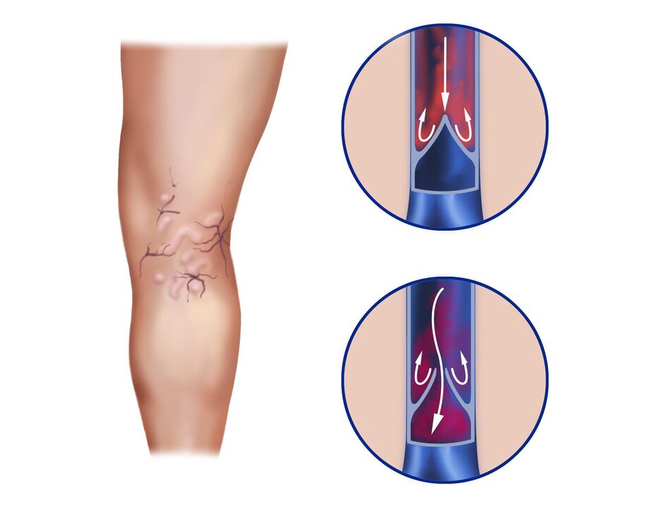 varicose veins